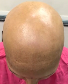 Alopecia universalis je velmi vzácná a nejzávažnější forma alopecie. Výsledkem je úplná ztráta vlasů i tělesného ochlupení.