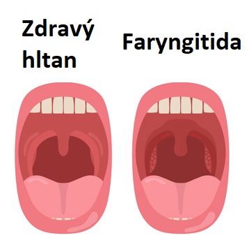 Faryngitida