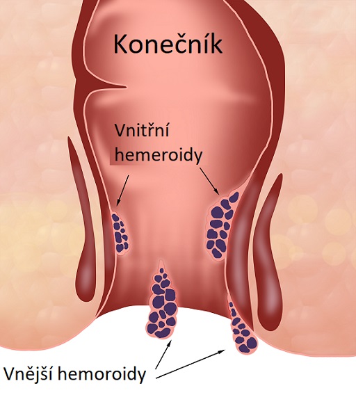 Vnější a vnitřní hemeroidy