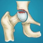 Osteonekróza (odumření kosti, avaskulární nekróza) – co je to – příznaky, příčiny a léčba