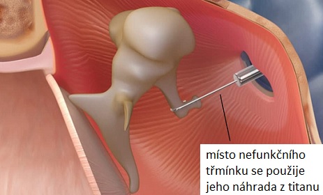 Chirurg se dostane do dutiny středního ucha a místo nefunkčního třmínku se použije jeho náhrada