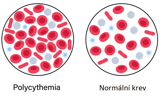 Polycythemia vera - ilustrace