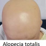 Alopecia totalis – co je to – příznaky, příčiny a léčba