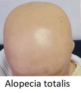 Alopecie totalis se může objevit v jakémkoli věku, ale je pravděpodobnější, že postihne teenagery a mladé lidi ve věku od 15 do 29 let.