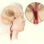 Ischemická cévní mozková příhoda – příznaky, příčiny a léčba