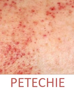 Petechie znamená výsev velice drobných prokrvácených míst v kůži (hemoragie), která vypadají jako rudofialové tečkování kůže. 