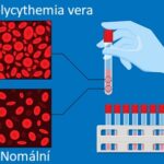 Polycythemia vera (primární polycytémie, Vaquezova choroba) – co je to – příznaky, příčiny a léčba