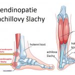 Tendinopatie (tendinóza) – příznaky, příčiny a léčba