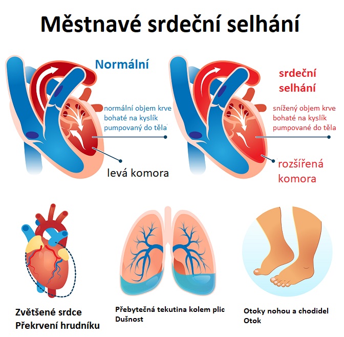 Městnavé srdeční selhání - ilustrace