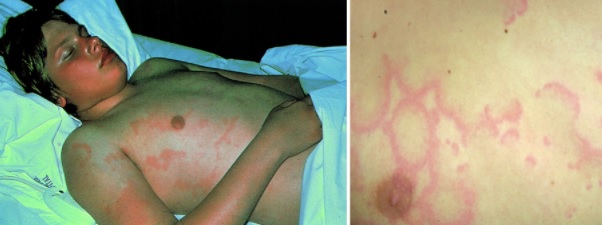 Erythema marginatum - nesvědivý kožní exantém charakterizovaný většími zarudlými kruhy se světlejšími středem