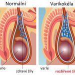 Varikokéla – co je to – příznaky, příčiny a léčba