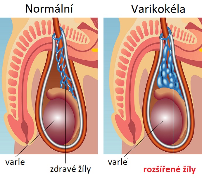 Varikokéla - ilustrace