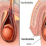 Varikokéla – co je to – příznaky, příčiny a léčba