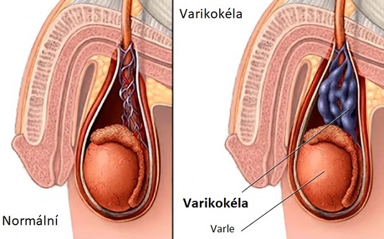 Většina varikokél se vyvíjí v průběhu času. Naštěstí je většina varikokély snadno diagnostikována a mnoho z nich nepotřebuje léčbu.