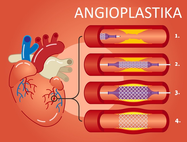 Takto může vypadat angioplastika