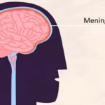 Zánět mozkových blan (meningitida) – příznaky, příčiny a léčba