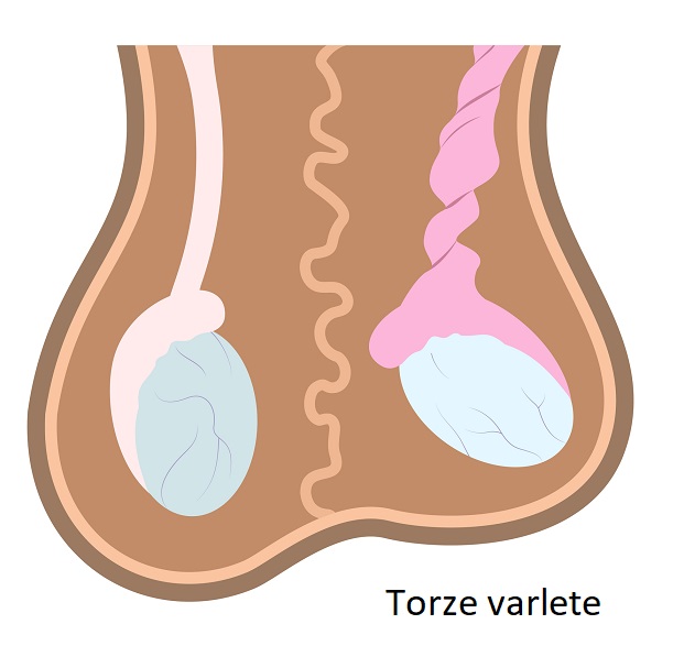 Torze varlete - ilustrace