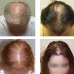 Androgenetická (androgenní) alopecie – co je to – příznaky, příčiny a léčba