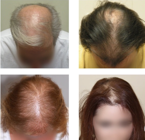 Takto vypadá androgenetická alopecie u mužů a žen