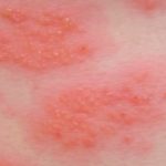 Alergický ekzém (alergická dermatitida) – co je to – příznaky, příčiny a léčba