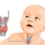 Kretenismus (vrozená hypotyreóza) – příznaky, příčiny a léčba