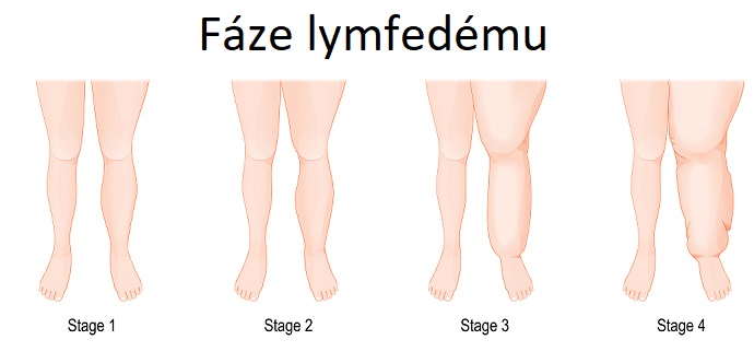 Fáze lymfedému