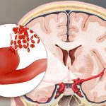 Mozkové aneurysma – vyboulení ve slabé části cévy v mozku – příznaky, příčiny a léčba