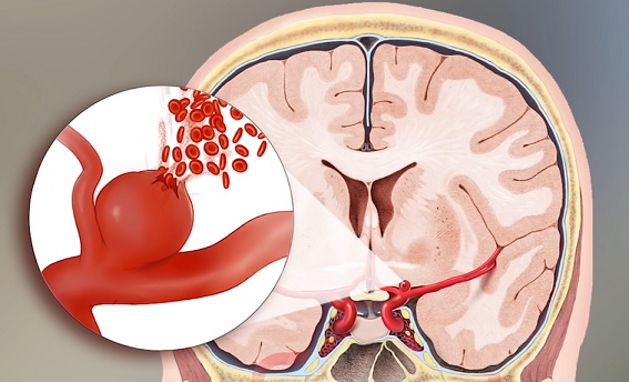 Obrázek - mozkové aneurysma