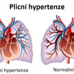Plicní hypertenze – co to je – příznaky, příčiny a léčba