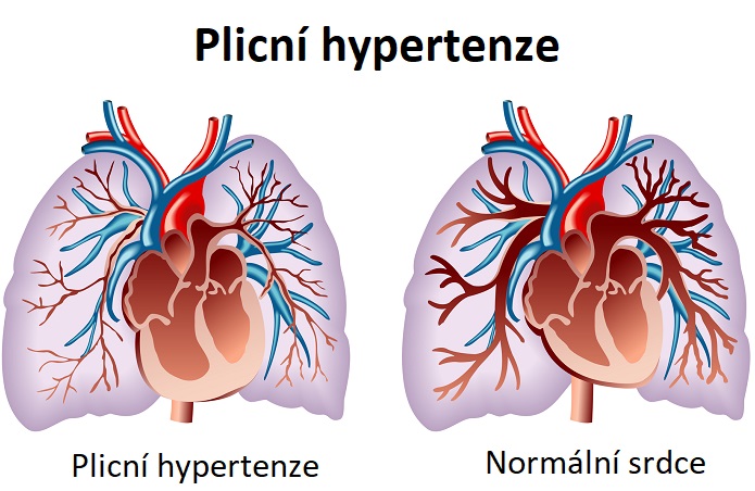 Plicní hypertenze - ilustrace