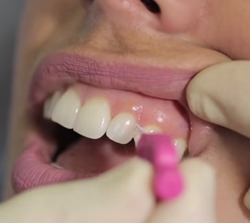 Co je lepší, mezizubní kartáček, nebo zubní nit?