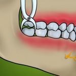 Zuby osmičky či zuby moudrosti – na co je máme? Vytrhnout nebo nechat?