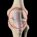 Skokanské koleno (patelární tendinitida) – co je to – příznaky, příčiny a léčba