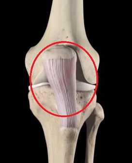 Patelární tendinitida, také známá jako skokanovo koleno, je nejčastější u sportovců, jejichž sporty zahrnují časté skákání - jako je basketbal a volejbal.
