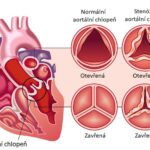 Aortální stenóza (stenóza či zúžení aortální chlopně) – příznaky, příčiny a léčba