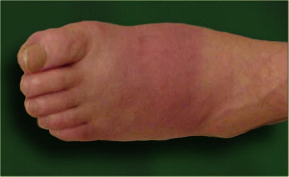 Charcotova osteoartropatie (Charcotova noha)