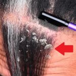 Seboroická dermatitida ve vlasech a její léčba – způsobuje seboroická dermatitida vypadávání vlasů?