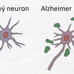 První příznaky Alzheimera – čím Alzheimerova choroba začíná?