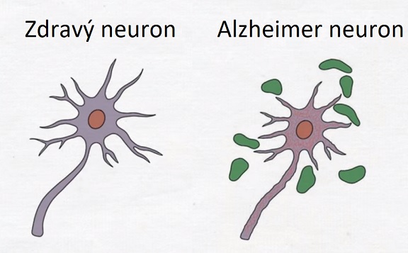 Neuron zdravého člověka a člověka s Alzheimerovou chorobou