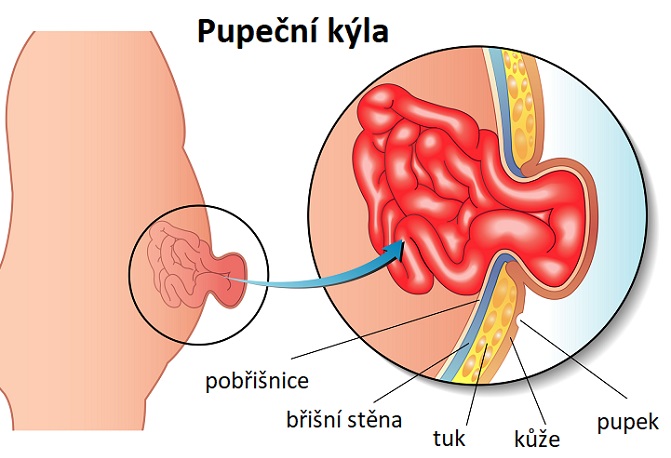 Pupeční kýla - ilustrace