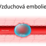 Vzduchová embolie (plynová embolie) – co je to – příznaky, příčiny a léčba