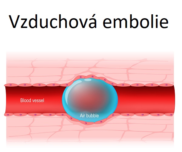 Takto může vypadat vzduchová embolie