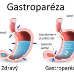 Gastroparéza – co je to – příznaky, příčiny a léčba