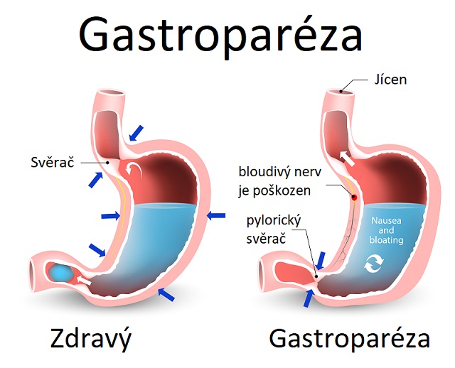 Gastroparéza - ilustrace