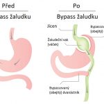 Žaludeční bypass – co je to a kdy se provádí