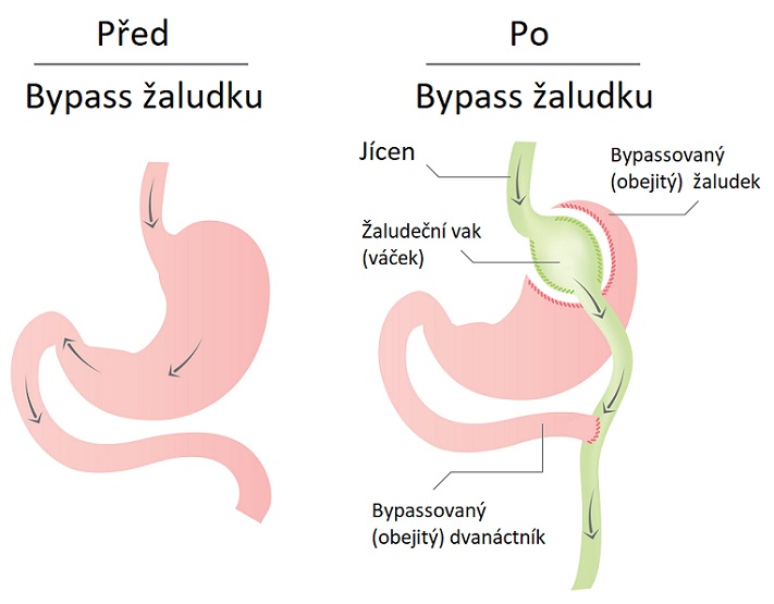 Ilustrace: Bypass žaludku