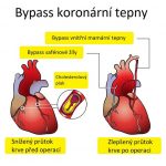 Co je koronární bypass či bypass srdce – kdy je potřeba?