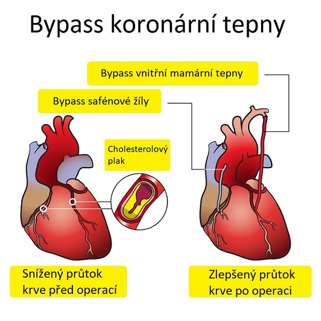 Jak dlouho trvá operace srdce bypass?