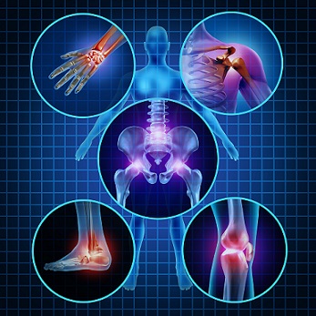 Migrační artritida je artritida, která migruje z jednoho kloubu do druhého.