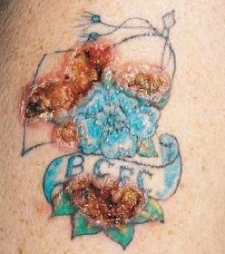 Alergie na modrý tetovací inkoust
